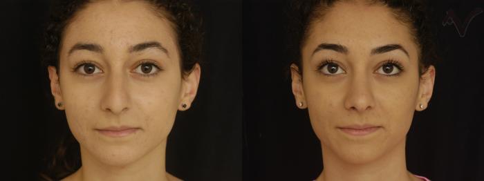 Before & After Rhinoplasty Case 297 Front View in Los Angeles, CA