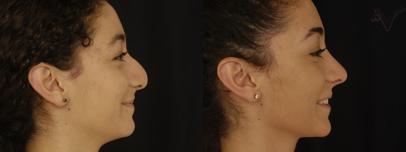 Before & After Rhinoplasty Case 297 Right Side View in Los Angeles, CA