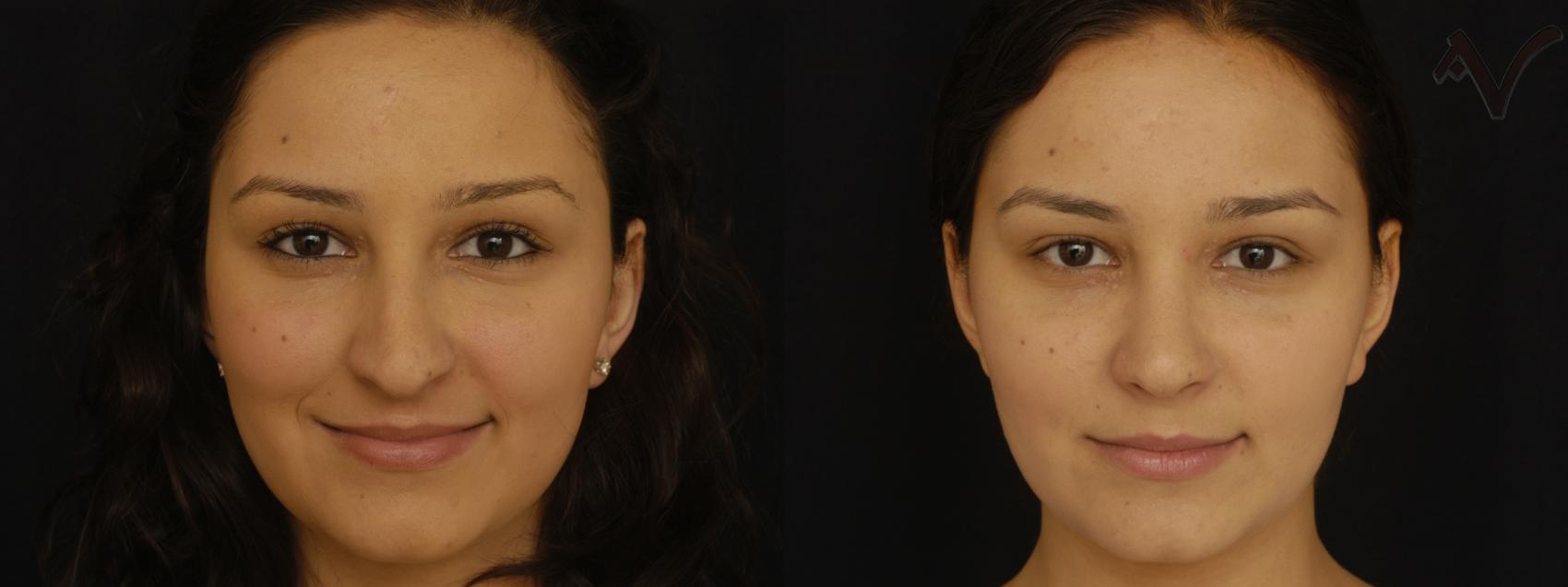 Before & After Rhinoplasty Case 299 Front View in Burbank, CA