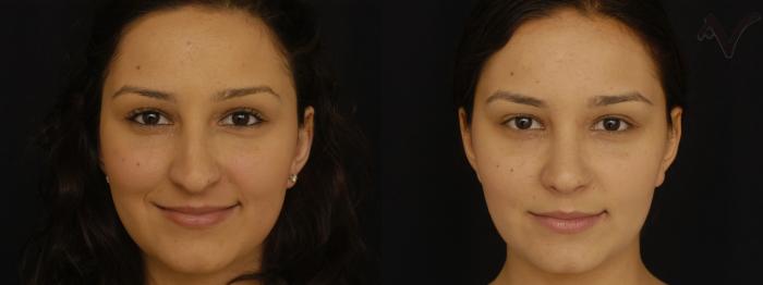 Before & After Rhinoplasty Case 299 Front View in Los Angeles, CA