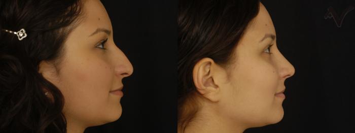 Before & After Rhinoplasty Case 299 Right Side View in Los Angeles, CA