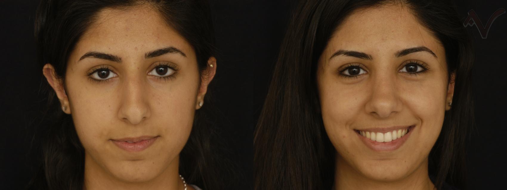 Before & After Rhinoplasty Case 301 Front View in Los Angeles, CA