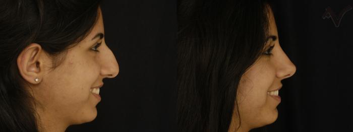 Before & After Rhinoplasty Case 301 Right Side View in Los Angeles, CA