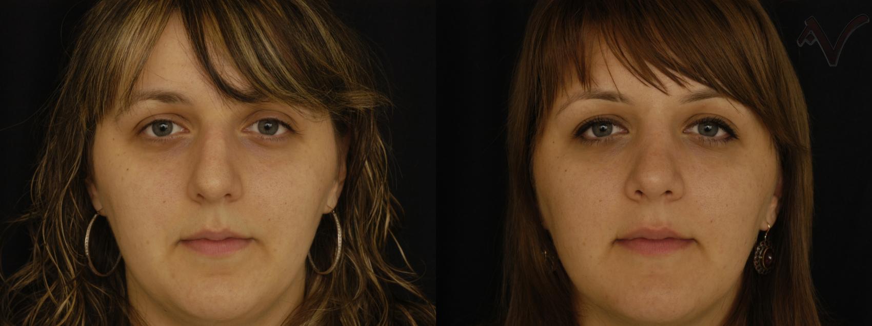 Before & After Rhinoplasty Case 303 Front View in Los Angeles, CA