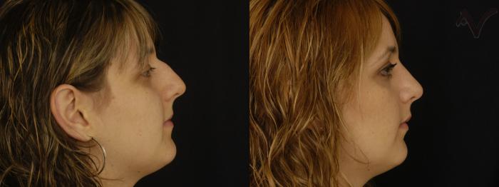 Before & After Rhinoplasty Case 303 Right Side View in Los Angeles, CA