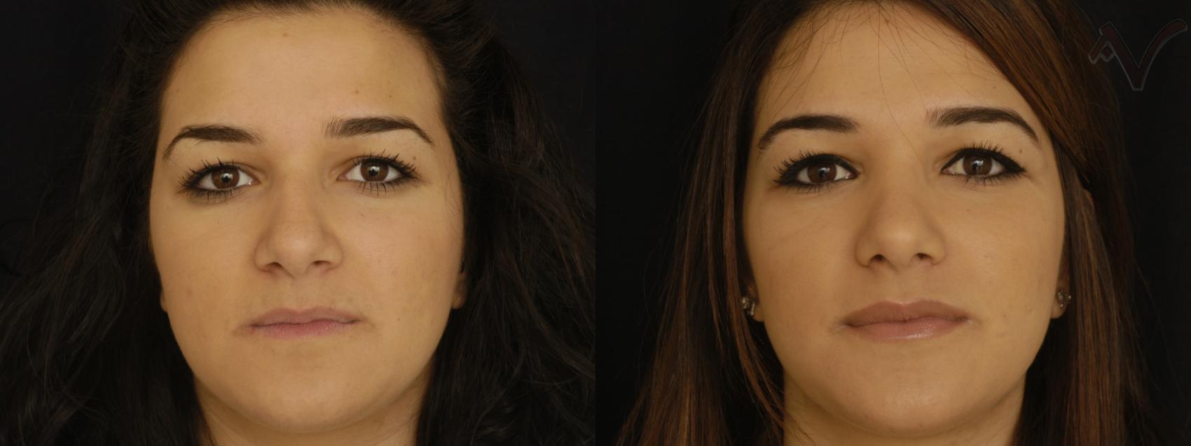 Before & After Rhinoplasty Case 304 Front View in Burbank, CA