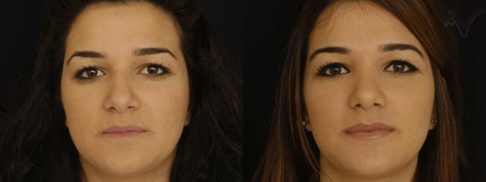 Before & After Rhinoplasty Case 304 Front View in Los Angeles, CA
