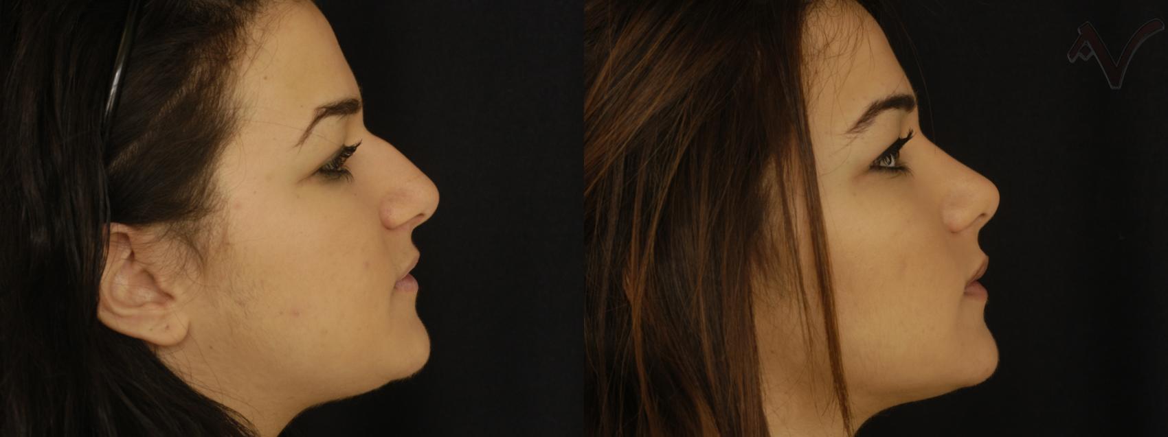 Before & After Rhinoplasty Case 304 Right Side View in Burbank, CA