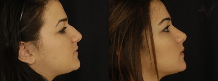 Before & After Rhinoplasty Case 304 Right Side View in Los Angeles, CA