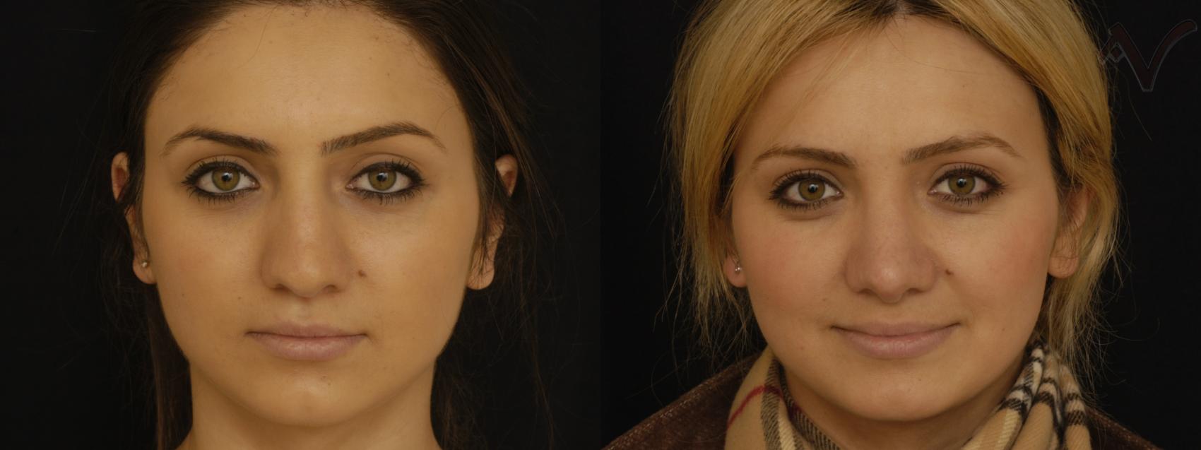 Before & After Rhinoplasty Case 305 Front View in Los Angeles, CA