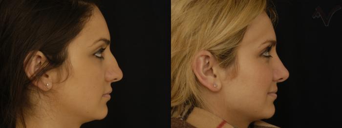 Before & After Rhinoplasty Case 305 Right Side View in Los Angeles, CA