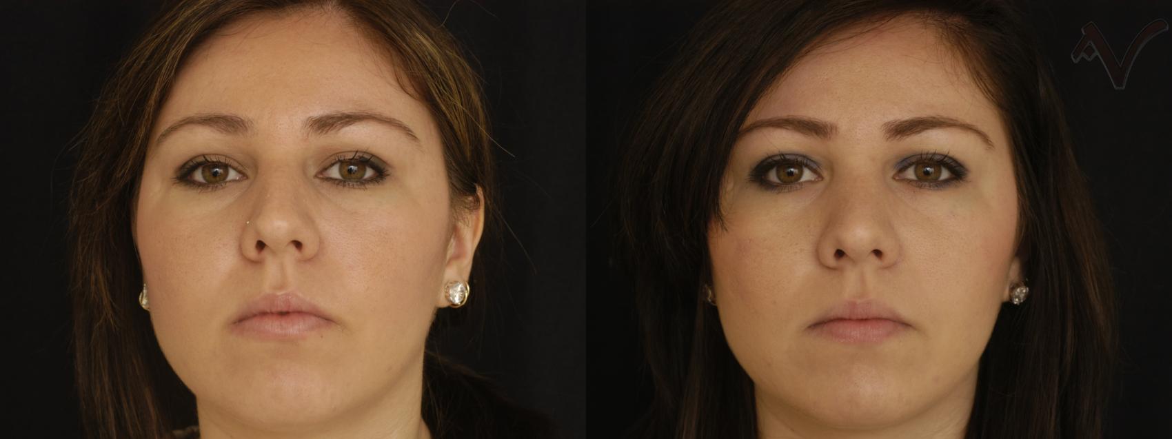 Before & After Rhinoplasty Case 308 Front View in Los Angeles, CA