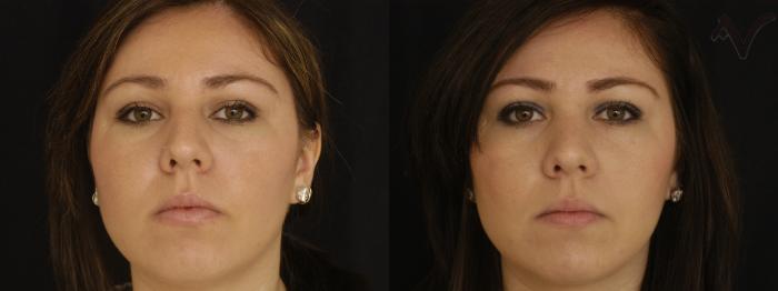 Before & After Rhinoplasty Case 308 Front View in Los Angeles, CA