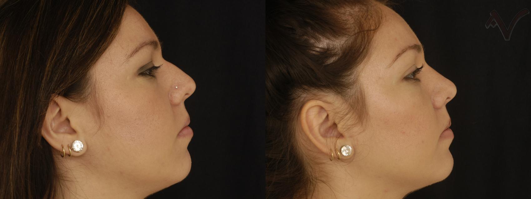 Before & After Rhinoplasty Case 308 Right Side View in Los Angeles, CA