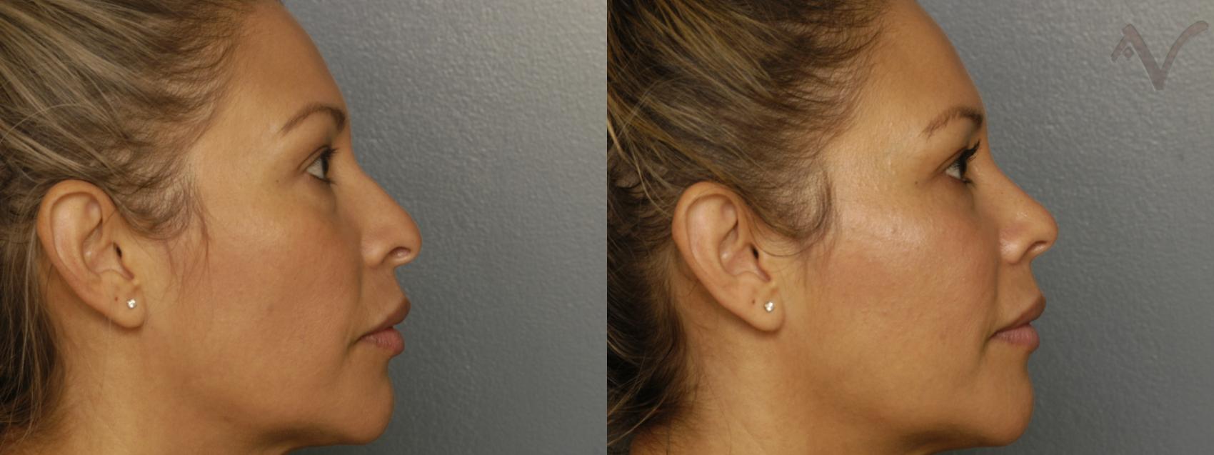 Before & After Rhinoplasty Case 309 Right Side View in Los Angeles, CA