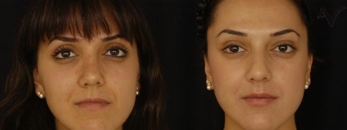 Before & After Rhinoplasty Case 310 Front View in Los Angeles, CA