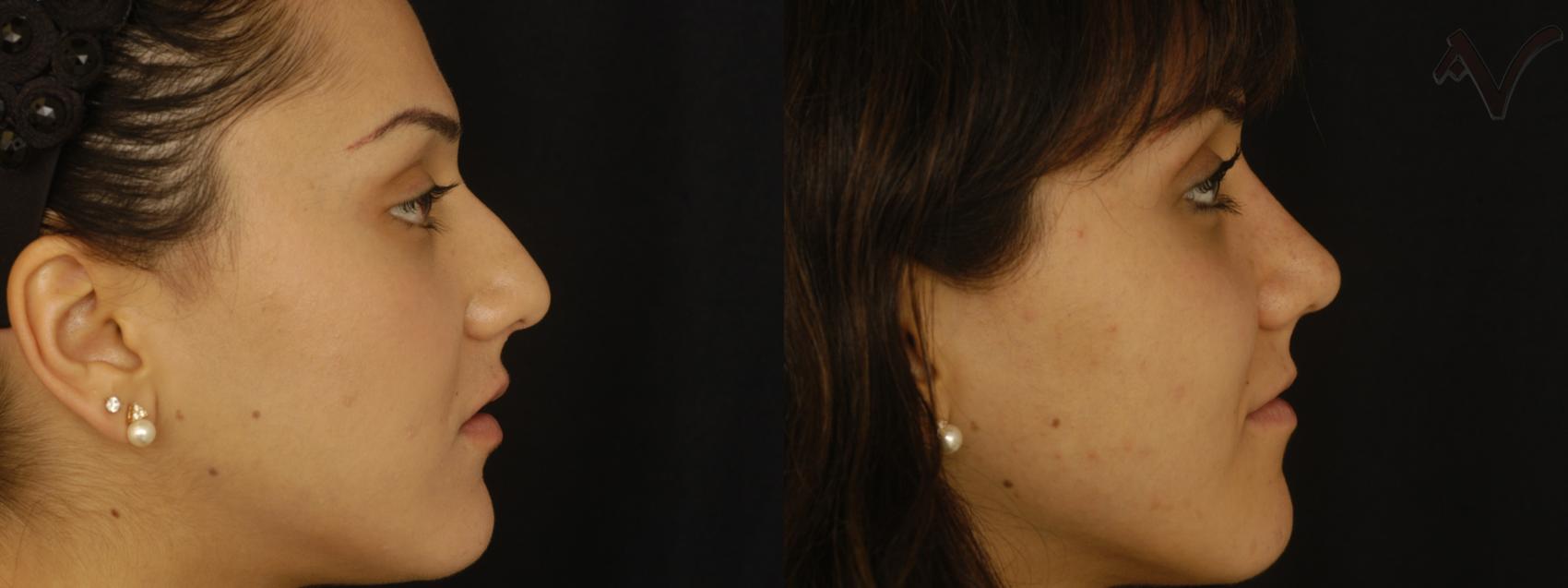 Before & After Rhinoplasty Case 310 Right Side View in Los Angeles, CA
