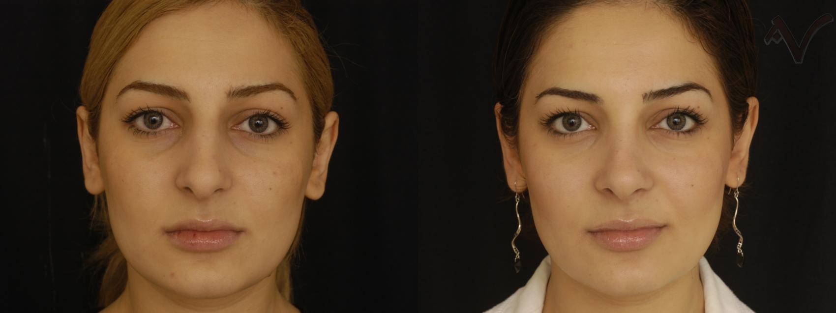 Rhinoplasty Before and After Pictures Case 311 | Los Angeles, CA ...