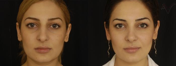 Before & After Rhinoplasty Case 311 Front View in Los Angeles, CA