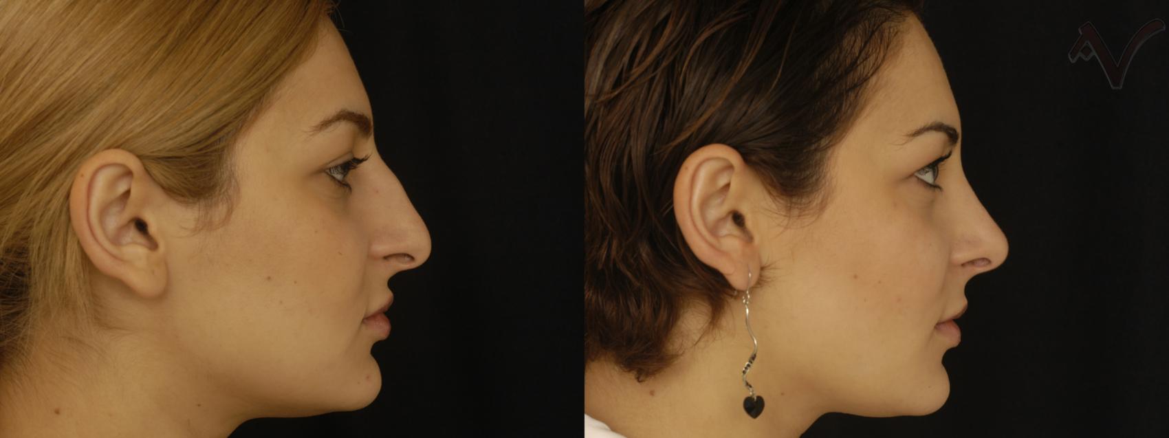 Before & After Rhinoplasty Case 311 Right Side View in Los Angeles, CA