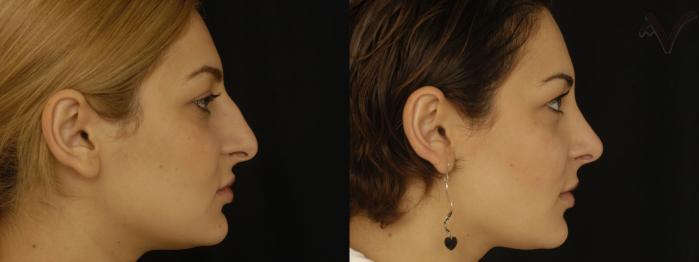 Before & After Rhinoplasty Case 311 Right Side View in Los Angeles, CA
