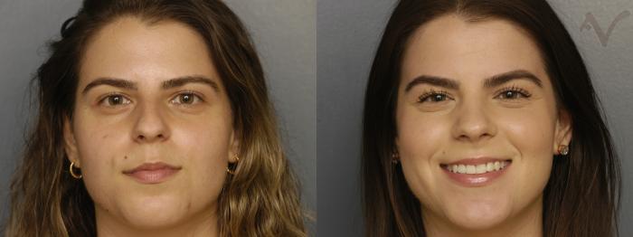 Before & After Rhinoplasty Case 325 Front View in Los Angeles, CA