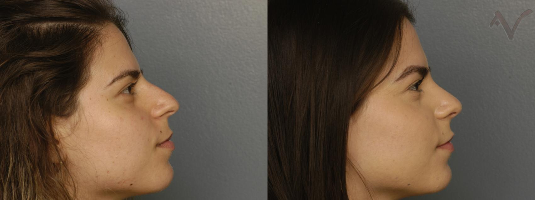 Before & After Rhinoplasty Case 325 Right Side View in Los Angeles, CA