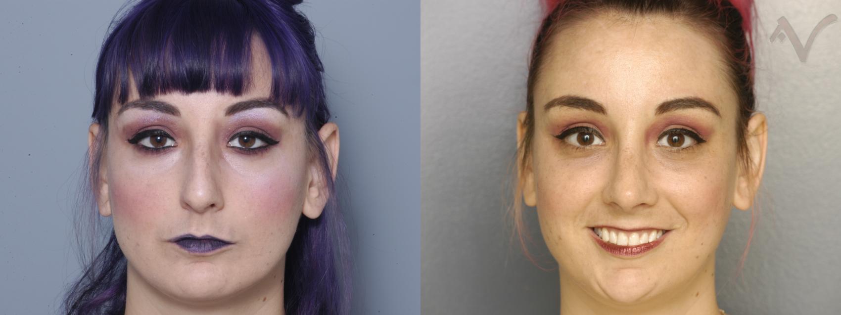 Before & After Rhinoplasty Case 326 Front View in Los Angeles, CA