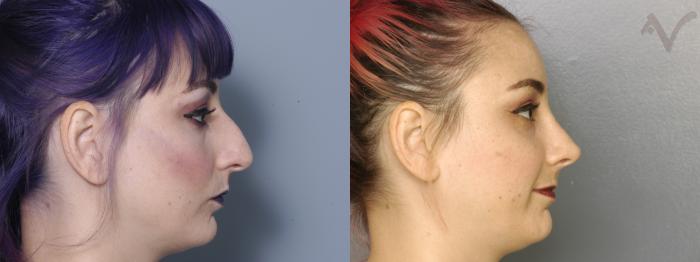 Before & After Rhinoplasty Case 326 Right Side View in Los Angeles, CA