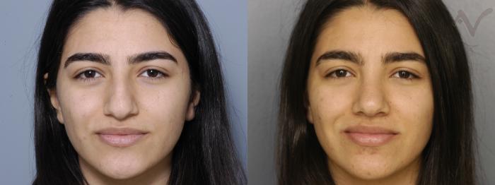 Before & After Rhinoplasty Case 327 Front View in Los Angeles, CA