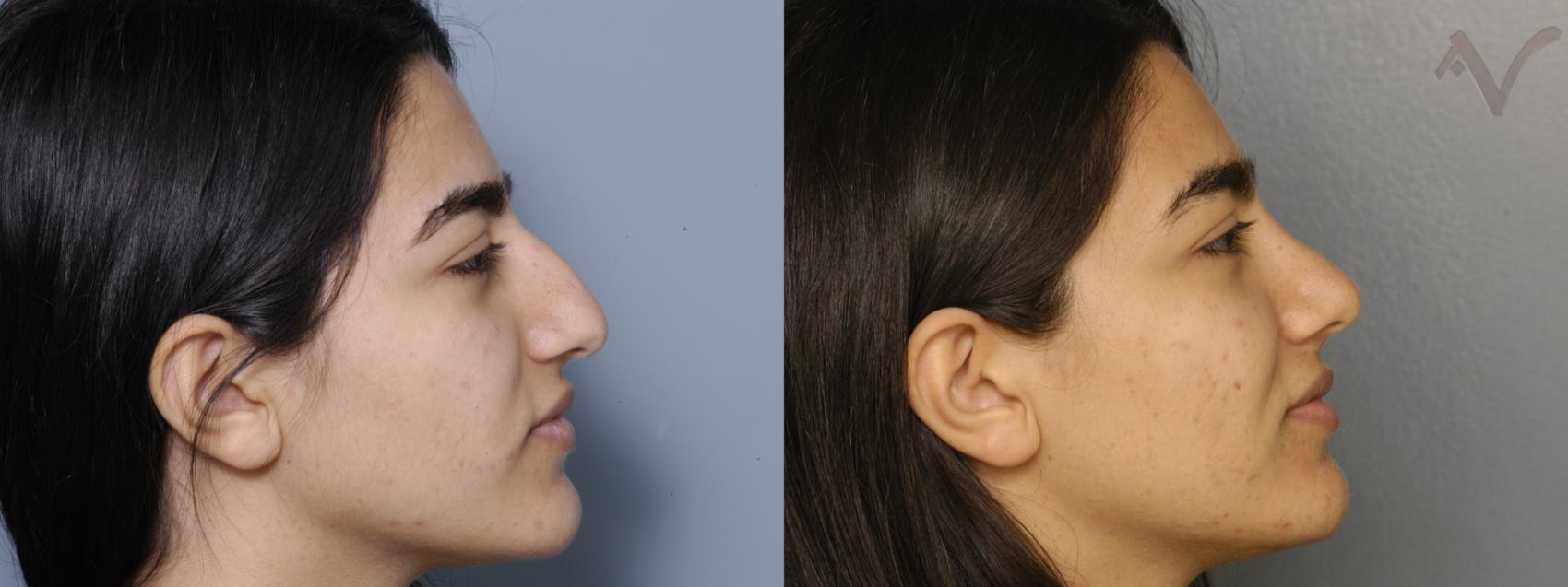 Before & After Rhinoplasty Case 327 Right Side View in Los Angeles, CA