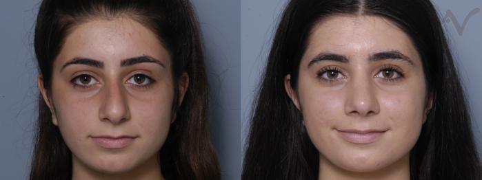 Before & After Rhinoplasty Case 328 Front View in Los Angeles, CA