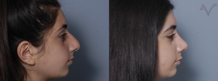 Before & After Rhinoplasty Case 328 Right Side View in Los Angeles, CA