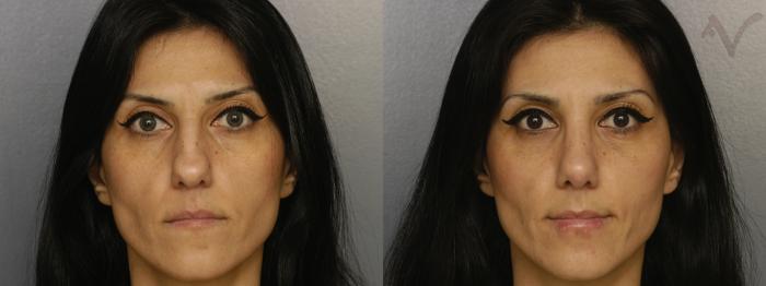 Before & After Rhinoplasty Case 329 Front View in Los Angeles, CA