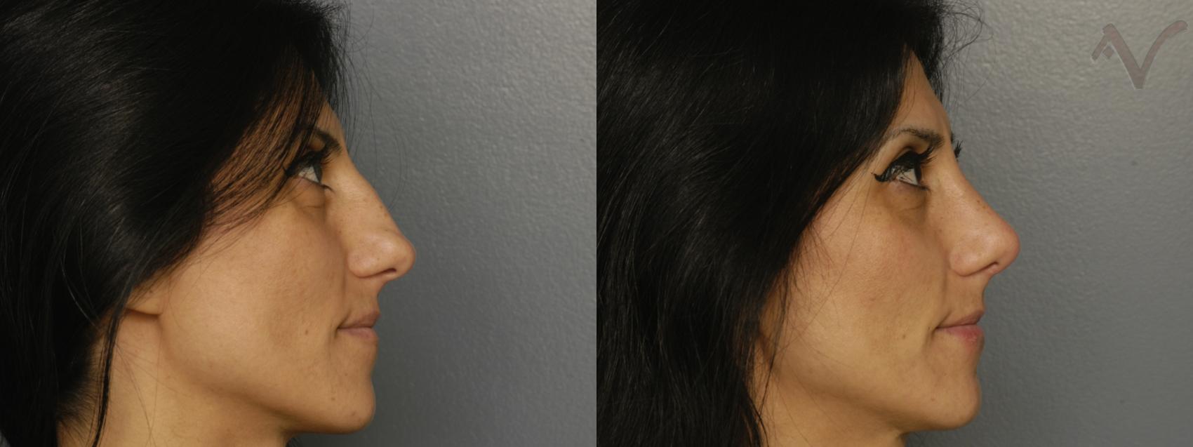 Before & After Rhinoplasty Case 329 Right Side View in Los Angeles, CA