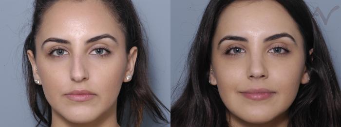 Before & After Rhinoplasty Case 330 Front View in Los Angeles, CA