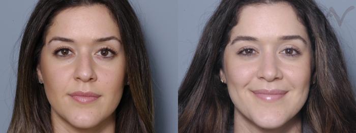 Before & After Rhinoplasty Case 331 Front View in Los Angeles, CA