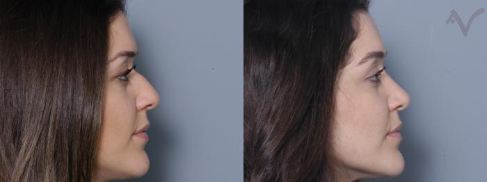 Before & After Rhinoplasty Case 331 Right Side View in Los Angeles, CA