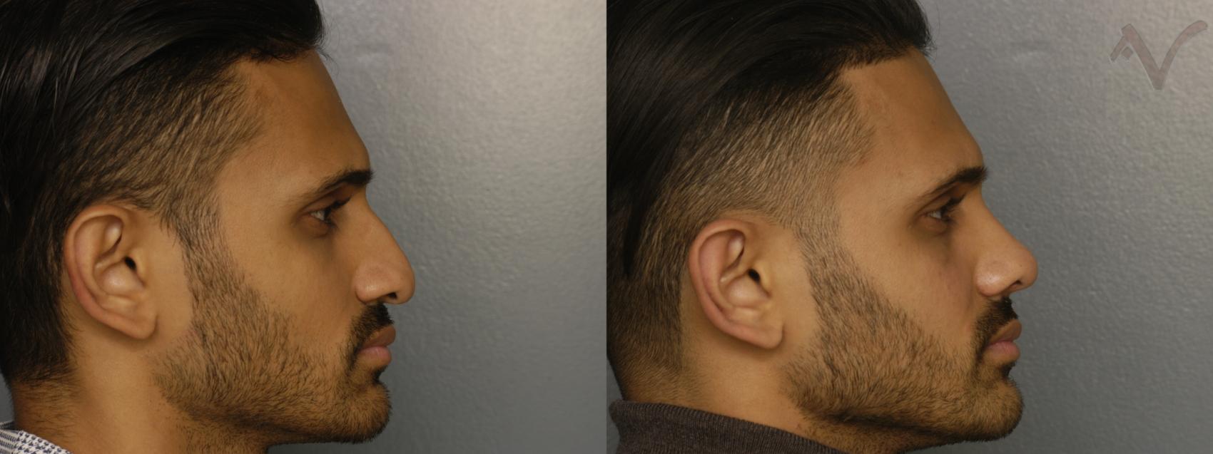 Before & After Rhinoplasty Case 332 Right Side View in Los Angeles, CA