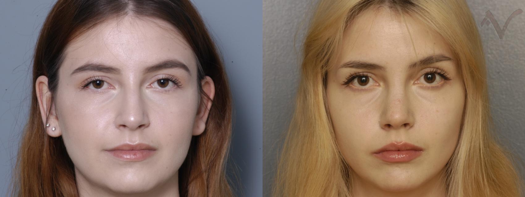 Before & After Rhinoplasty Case 333 Front View in Los Angeles, CA