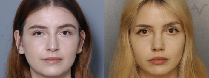 Before & After Rhinoplasty Case 333 Front View in Los Angeles, CA