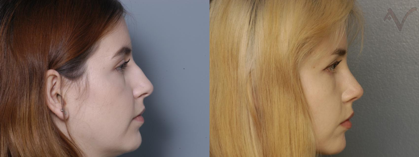 Before & After Rhinoplasty Case 333 Right Side View in Los Angeles, CA