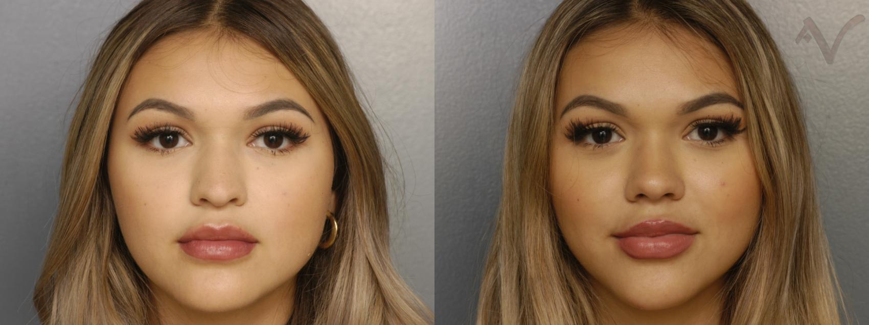 Before & After Rhinoplasty Case 335 Front View in Los Angeles, CA