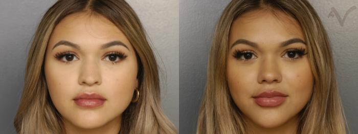 Before & After Rhinoplasty Case 335 Front View in Los Angeles, CA