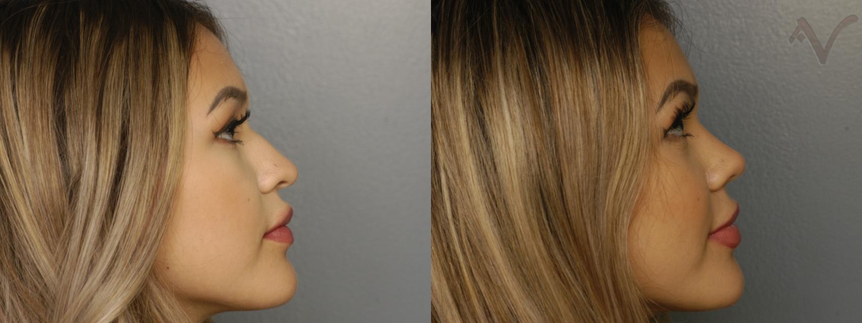 Before & After Rhinoplasty Case 335 Right Side View in Los Angeles, CA
