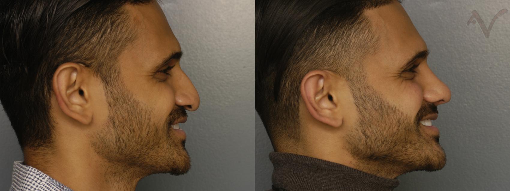 Before & After Rhinoplasty Case 359 Right Side View in Los Angeles, CA