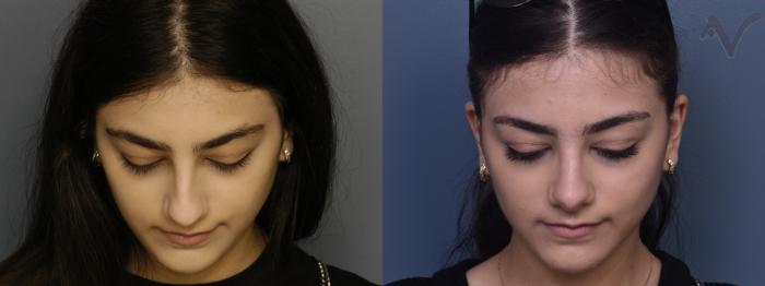 Before & After Rhinoplasty Case 366 Downward Gaze View in Los Angeles, CA