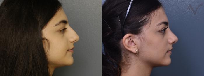 Before & After Rhinoplasty Case 366 Left Side View in Los Angeles, CA