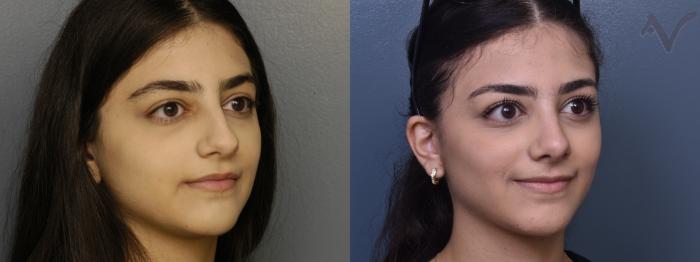 Before & After Rhinoplasty Case 366 Right Oblique View in Los Angeles, CA