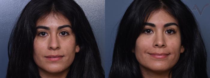 Before & After Rhinoplasty Case 369 Front View in Los Angeles, CA